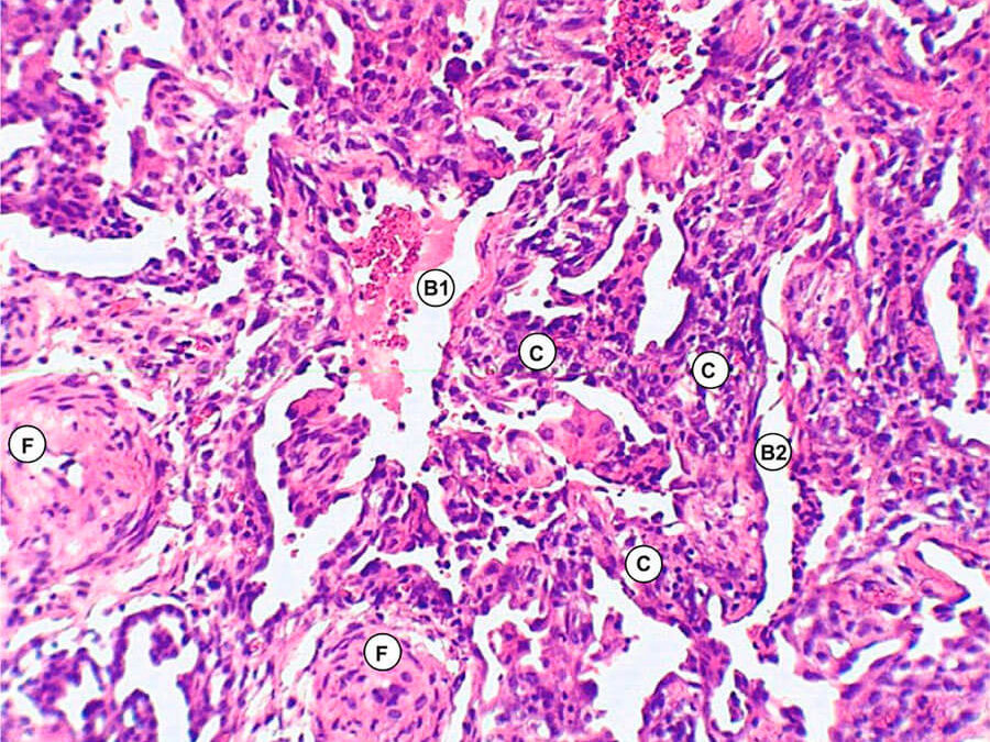 Biopsia pulmonar a cielo abierto como diagnóstico de fibrosis pulmonar idiopática