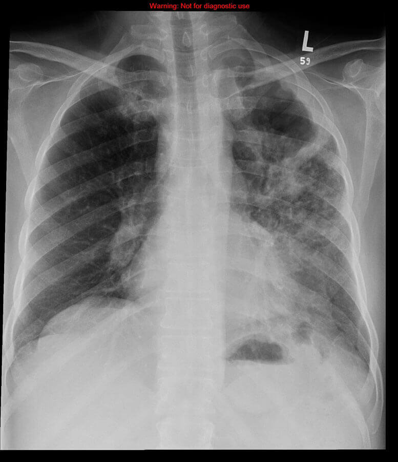 Etiología de la fibrosis pulmonar: secuelas de tuberculosis